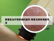 那里能治疗银屑病的医院 哪里治银屑病最专业