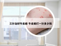 三针治好牛皮癣 牛皮癣打一针多少钱