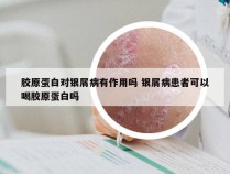 胶原蛋白对银屑病有作用吗 银屑病患者可以喝胶原蛋白吗