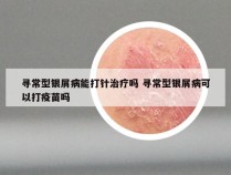寻常型银屑病能打针治疗吗 寻常型银屑病可以打疫苗吗