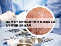 银屑病关节炎会引起脊柱疼吗 银屑病关节炎会导致强直性脊柱炎吗