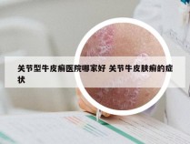 关节型牛皮癣医院哪家好 关节牛皮肤癣的症状
