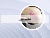这是牛皮癣吗