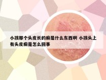 小孩那个头皮长的癣是什么东西啊 小孩头上有头皮癣是怎么回事