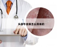 头部牛皮癣怎么得来的