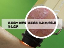 银屑病全身脱皮 银屑病脱皮,越来越痒,是什么症状