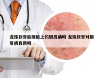 龙珠软膏能擦脸上的银屑病吗 龙珠软膏对银屑病有用吗
