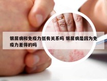 银屑病和免疫力低有关系吗 银屑病是因为免疫力差得的吗