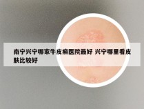 南宁兴宁哪家牛皮癣医院最好 兴宁哪里看皮肤比较好