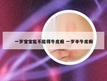 一岁宝宝能不能得牛皮癣 一岁半牛皮癣