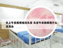 头上牛皮癣用啥洗头膏 头皮牛皮肤癣用什么洗发水