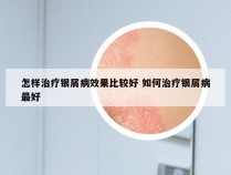 怎样治疗银屑病效果比较好 如何治疗银屑病最好