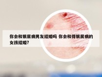 你会和银屑病男友结婚吗 你会和得银屑病的女孩结婚?