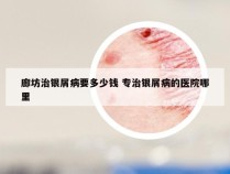 廊坊治银屑病要多少钱 专治银屑病的医院哪里