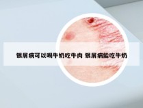 银屑病可以喝牛奶吃牛肉 银屑病能吃牛奶
