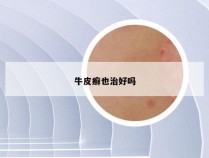 牛皮癣也治好吗