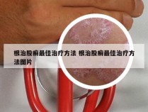 根治股癣最佳治疗方法 根治股癣最佳治疗方法图片