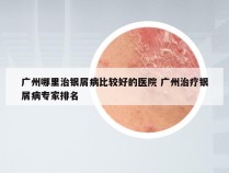 广州哪里治银屑病比较好的医院 广州治疗银屑病专家排名