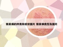 银屑病的种类和症状图片 银屑病类型及图片