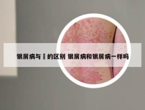 银屑病与廯的区别 银屑病和银屑病一样吗