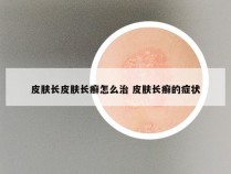 皮肤长皮肤长癣怎么治 皮肤长癣的症状