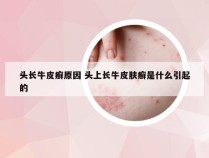 头长牛皮癣原因 头上长牛皮肤癣是什么引起的