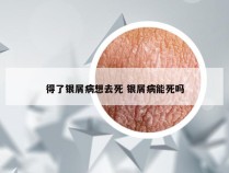得了银屑病想去死 银屑病能死吗