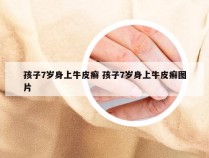 孩子7岁身上牛皮癣 孩子7岁身上牛皮癣图片