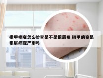 指甲病变怎么检查是不是银屑病 指甲病变是银屑病变严重吗