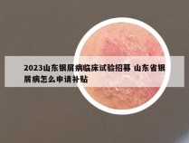 2023山东银屑病临床试验招募 山东省银屑病怎么申请补贴