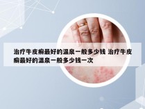 治疗牛皮癣最好的温泉一般多少钱 治疗牛皮癣最好的温泉一般多少钱一次