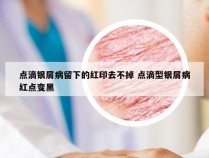 点滴银屑病留下的红印去不掉 点滴型银屑病红点变黑