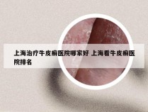 上海治疗牛皮癣医院哪家好 上海看牛皮癣医院排名