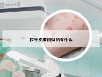 和牛皮癣相似的有什么