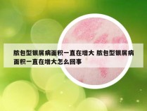脓包型银屑病面积一直在增大 脓包型银屑病面积一直在增大怎么回事