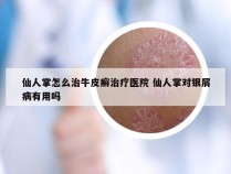 仙人掌怎么治牛皮癣治疗医院 仙人掌对银屑病有用吗
