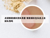 点滴银屑病长到头发里 银屑病长在头皮上会掉头发吗