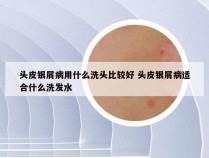 头皮银屑病用什么洗头比较好 头皮银屑病适合什么洗发水