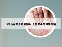 3岁小孩会患银屑病吗 儿童会不会得银屑病