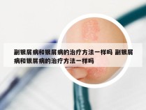 副银屑病和银屑病的治疗方法一样吗 副银屑病和银屑病的治疗方法一样吗