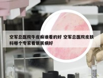 空军总医院牛皮癣谁看的好 空军总医院皮肤科哪个专家看银屑病好