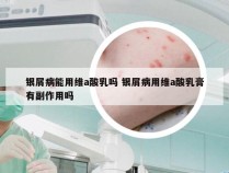 银屑病能用维a酸乳吗 银屑病用维a酸乳膏有副作用吗