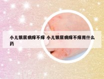 小儿银屑病痒不痒 小儿银屑病痒不痒用什么药
