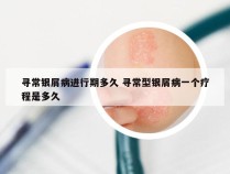 寻常银屑病进行期多久 寻常型银屑病一个疗程是多久