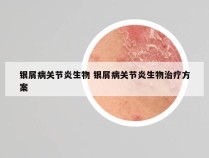 银屑病关节炎生物 银屑病关节炎生物治疗方案