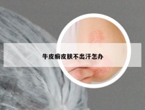 牛皮癣皮肤不出汗怎办