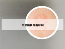 牛皮癣和皮癣区别