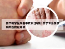 南宁哪家医院看牛皮癣过敏好 南宁专治皮肤病的医院在哪里
