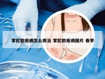 掌跎脓疱病怎么根治 掌跎脓疱病图片 春季