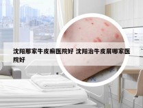沈阳那家牛皮癣医院好 沈阳治牛皮屑哪家医院好